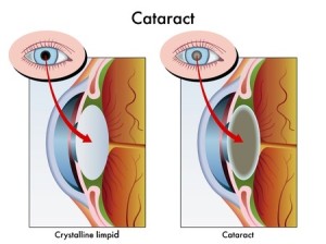 doorsnede oog bij cataract